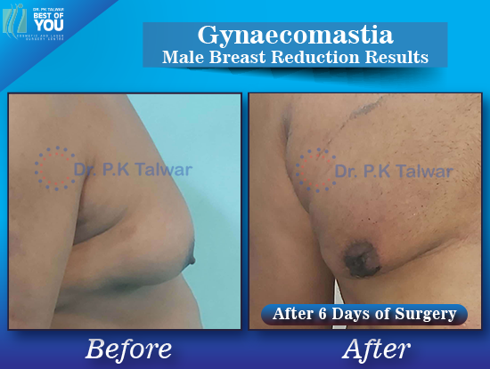 Gynaecomastia before after image